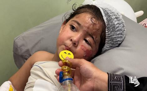 مريم غانم.. طفولة مثقلة بالحروق والفقد في غزة